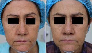 Before and after clinical photographs. After treatment with MAL+daylight, facial skin appears lighter, with improvement of frontal and external eye wrinkles.