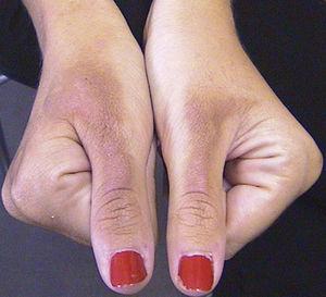 Hiperpigmentación homogénea en dorso del primer dedo de ambas manos, asintomáticas, que se iniciaron varios días tras realizar mojitos en una fiesta en la playa.
