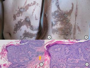 A) Lesiones inflamatorias sobre el nevus epidérmico en tronco y extremidad superior izquierda, a modo de placas redondeadas y ovaladas de aspecto psoriasiforme. B) Distribución parcheada de las lesiones en la espalda dejando áreas de nevus epidérmico respetado. C) La biopsia de una de las lesiones muestra la arquitectura del nevus epidérmico con acantosis y papilomatosis, junto con un infiltrado linfocitario en dermis superficial (flecha) (H&E ×10). D) Área de paraqueratosis con discreta espongiosis (H&E ×20).