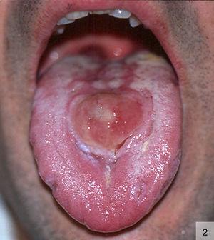 Chancro pseudotumoral en el dorso de la lengua (por cortesía del Dr. Ramón Pujol).