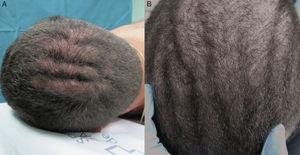 A. Plegamiento anteroposterior del cuero cabelludo (paciente 1). B. Plegamiento anteroposterior del cuero cabelludo (paciente 2).