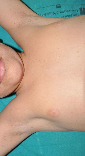 Múltiples efélides axilares en un paciente de 8 años. Además de la afectación axilar típica se aprecian numerosas pecas en el cuello y el mentón.