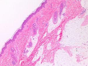 La biopsia de piel mostró un acúmulo excesivo de tejido adiposo en la dermis superficial.