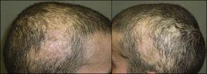 Placas de alopecia parietotemporales bilaterales.