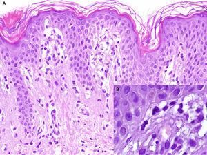 A. H-Ex100. Biopsia del borde de la lesión. Crestas epidérmicas alargadas con infiltrado linfocitario liquenoide localizado en el techo de las papilas dérmicas y vacuolización de la membrana basal. B. H-Ex400. A mayor detalle se observan múltiples queratinocitos apoptóticos.
