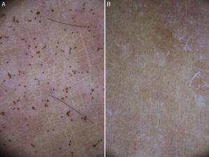 Dermoscopic findings in Pelagia noctiluca stings. Brown dots. (A) Brown dots of 0.1mm diameter in a sting of 1-week duration. (B) The same lesion at 21 days showing complete disappearance of brown dots.