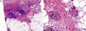A) Afectación predominante de dermis media y profunda, con áreas de colágeno degenerado rodeadas de histiocitos dispuestos en empalizada, y un infiltrado de linfocitos y células plasmáticas. B) El proceso inflamatorio se extendía al tejido celular subcutáneo, con la presencia en los septos de tejido conectivo hipodérmico de focos de colágeno degenerado rodeado de histiocitos conformando granulomas de aspecto vagamente sarcoideo.