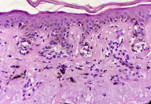 Melanoma in situ: biopsia de piel de la cara. Nidos de melanocitos en la unión dermo-epidérmica, con densos depósitos de elastosis solar. H-E ×200.