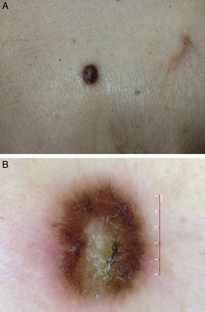 A) Imagen de la lesión tumoral de color negro, superficie queratósica sobre base eritematosa. B) Hipopigmentación central, proyecciones radiales y glóbulos en la periferia. En el polo inferior vasos tortuosos.