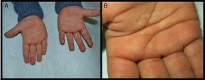 Ampollas y áreas eritematosas en las palmas de las manos. A: Visión general. B: Detalle de las lesiones.