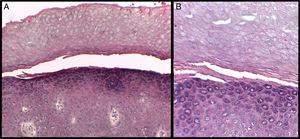 A) Separación de la epidermis entre las capas córnea y granulosa (hematoxilina-eosina ×10). B) Detalle a mayor aumento. Obsérvese el aspecto de la capa córnea por encima del punto de separación, con células grandes y redondeadas (hematoxilina-eosina ×20).