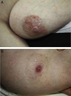 A) Placa eritemato-escamosa, netamente delimitada, exudativa, en aréola mamaria derecha. B) Resolución completa de las lesiones de aréola mamaria derecha tras 6 meses de tratamiento tópico.