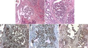Estudio anatomopatológico de pápula de escote. A) Múltiples formaciones de aspecto glomeruloide a nivel dérmico (hematoxilina-eosina x10). B) Imagen a mayor detalle (hematoxilina-eosina x20). C) Tinción CD 34+ exclusivamente a nivel de los vasos capilares (hematoxilina-eosina x20). D) Tinción CD31+ de vasos sinusoidales y capilares del hemangioma glomeruloide (hematoxilina-eosina x20). E) Tinción VEGF+ presente a nivel de ambos tipos de vasos (hematoxilina-eosina x20).