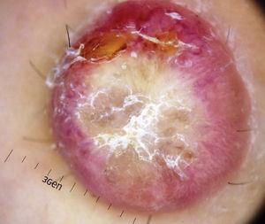 Dermatoscopia de la lesión que muestra un parche central blanquecino descamativo de aspecto cicatricial y un área periférica eritematosa vascularizada.