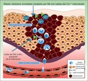 Los mecanismos de resistencia que se pueden ver involucrados en la terapia con mebutato de ingenol son los niveles de Ca++ intracelular, a nivel de los receptores de unión y del propio estado inmunitario del paciente. Ca++: calcio; MI: mebutato de ingenol; PKC: proteína quinasa C; QA: queratosis actínica.