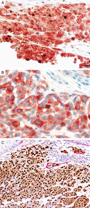 Immunohistochemical studies for prognostic factors. (A) Mart-1/Ki67 cocktail highlights the melanoma cells (red, cytoplasmic) with increased nuclear positivity for Ki67 (brown, nuclear) (magnification 200×). (B) Mart-1/PHH3 cocktail highlights a mitotic figure (brown) in a melanoma (red, cytoplasmic) (magnification 200×). (C) MITF/D2-40 reveals the presence of lymphovascular (red) space invasion by melanoma cells (brown, nuclear) (magnification × 100).
