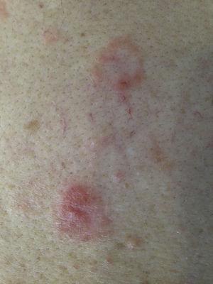 Imagen clínica. Lesiones pápulo-vesiculosas de base eritematosa y morfología anular afectando a la espalda.