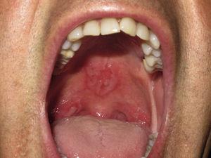 Lesiones en forma de erosiones en el paladar duro y el pilar tonsilar derecho.