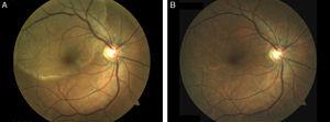 A) Lesión placoide de gran tamaño, circular y de coloración amarillenta, localizada en el epitelio pigmentado de la retina en la mácula. B) Imagen después del tratamiento, que muestra normalización del fondo de la retina.