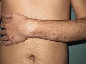 Múltiples tumores eritematovioláceos en el brazo y el antebrazo izquierdo siguiendo un patrón lineal zosteriforme.