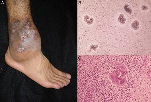 Actinomicetoma de pie (A). Granos de Nocardia sp., al examen directo (KOH, ×10) (B); y biopsia (H-E, ×40) (C).