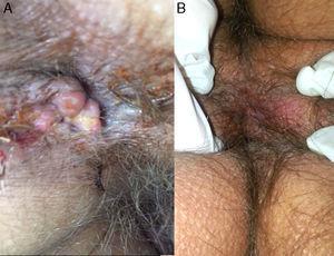 Clinical image of the perianal lesion. (A) Prior to diagnosis. (B) After 2 months of treatment.