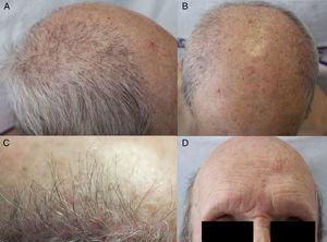 A y B) Retroceso de la línea de implantación del pelo bitemporal y parietal, sobre AGA asociada. C) Detalle de la hiperqueratosis perifolicular. D) Alopecia total de cejas.