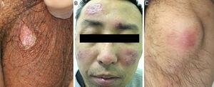 In 2006, the patient developed solitary scrotum ulcer (a), along with oral ulcers, folliculitis, and erythema nodosum-like lesions. In 2011, the patient developed tender, infiltrative erythematous plaques on the forehead and cheeks (b), and erythema nodosum-like lesion on the knee (c).