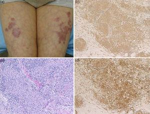 (a) Reddish plaques on the thigh along with livedoid changes. (b) Histological features showing sarcoidal granuloma, which are immunoreactive for TNF-α (c) and IL-17 (d) (original magnification: b; ×400, c; ×200, d; ×200).