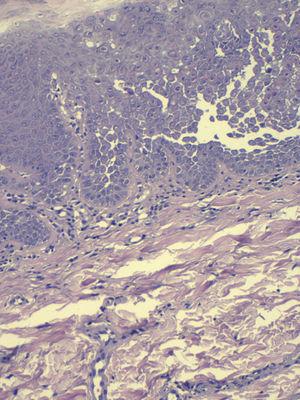 Biopsia tipo punch (H&E ×20) de una pápula vulvar donde se observa pápula intraepidérmica acantolítica con disqueratosis.