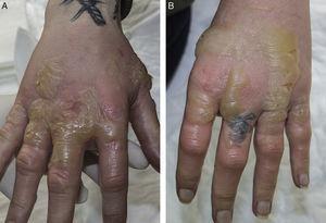 A) Eritema y edema en dorso de la mano derecha con grandes ampollas tensas de contenido transparente. B) Lesiones similares en dorso de la mano izquierda.