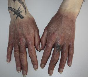 Pigmentación difusa en dorso de las manos, tras la resolución de las lesiones. Destaca el límite neto en la zona distal de muñecas y el respeto de la zona del anillo en el cuarto dedo de la mano derecha.