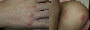 A) Placas eritematosas bien delimitadas sobre las que asientan ampollas tensas de contenido seroso localizadas sobre las articulaciones metacarpofalángicas. B) Lesiones similares en la rodilla izquierda, con una morfología artefacta.