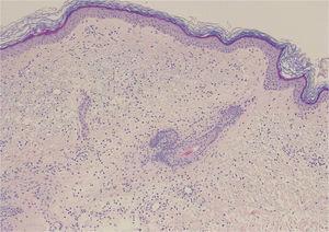 Edema junto con un infiltrado inflamatorio moderado en dermis superficial, formado por linfocitos y neutrófilos, con ocasionales imágenes de leucocitoclasia. No se observa extravasación de hematíes, hemosiderófagos ni lesiones de necrosis fibrinoide en la pared vascular (H&E ×20).