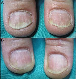 (A) Bilateral Distal onycholisis before treatment. The right thumbnail was treated with PDL while the left thumbnail with Nd:YAG. (B) After four sessions of PDL (right thumbnail) and four sessions of Nd:YAG (left thumbnail).
