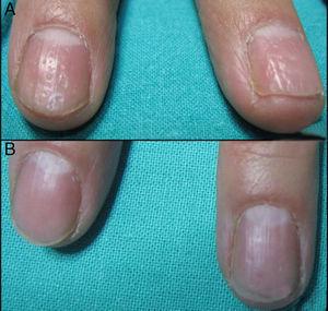 (A) Nail matrix psoriasis of the right hand before treatment. (B) After four sessions of PDL.