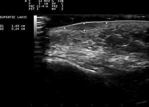 Estudio ultrasonográfico del nódulo de la mejilla izquierda. Se observa una lesión dérmica, hipoecoica, ovalada, bien delimitada, sin depósitos de calcio en su interior.