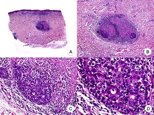 Micosis fungoide siringotrópica. A. Vista panorámica que muestra un infiltrado en banda en dermis reticular y periglandular. B. A mayor aumento se observa la afectación de las glándulas ecrinas por un infiltrado denso de linfocitos. C, D. A mayor aumento se observan linfocitos atípicos rodeando una glándula ecrina con siringometaplasia.