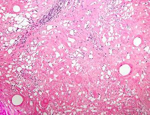 Imagen en «queso suizo», esclerosis difusa de dermis reticular y tejido celular subcutáneo con seudoquistes vacíos.