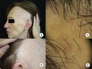 Manifestaciones clínicas en la alopecia frontal fibrosante. A. Se observa recesión de la línea de implantación frontotemporal del cabello, que se extiende a la región retroauricular. B. La piel de la zona alopécica presenta cambios cicatriciales en su superficie, con pérdida de los orificios foliculares, palidez uniforme y visualización de la red vascular. C. Imagen con tricoscopia de la línea de implantación frontal del cabello, en la que se observa ausencia de los ostium foliculares, eritema, descamación perifolicular y capilares ramificados. D. Imagen con tricoscopia de la región retroauricular en la que se observan cambios similares a la anterior.