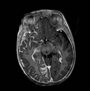 RM craneal, T1 post-gadolinio. Corte axial a la altura del mesencéfalo, mostrando el engrosamiento y captación leptomeníngea típico de la angiomatosis leptomeníngea en un paciente con SSW.