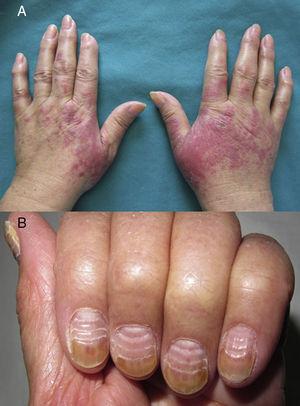 Síndrome PATEO: afectación cutánea y ungueal por docetaxel. A. Caso 1: placas eritematovioláceas en el dorso de las manos y en la falange proximal. B. Afectación ungueal en el caso n.° 3: líneas paralelas de Beau y onicolisis del tercio distal de la tabla ungueal.