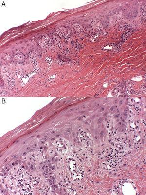 Estudio histológico de la lesión en el dorso de la mano del caso n.° 2: A. Epidermis hiperqueratósica con paraqueratosis, focos de degeneración vacuolar de la basal e infiltrado perivascular y en banda con escasos eosinófilos (hematoxilina-eosina, ×20). B. Mayor aumento (×40) evidenciando queratinocitos necróticos en epidermis.