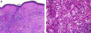 Anatomía patológica del xantogranuloma orbitario del adulto. Infiltrado difuso en la dermis compuesto por histiocitos y linfocitos, hematoxilina-eosina (HE), ×4. (a). A mayores aumentos los histiocitos presentan múltiples vacuolas lipídicas, HE, ×20 (b).