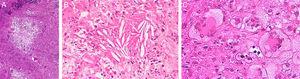 Anatomía patológica del xantogranuloma necrobiótico. Infiltrado inflamatorio granulomatoso compuesto por histiocitos y células inflamatorias acompañantes, hematoxilina-eosina (HE), ×4 (a). Se aprecia degeneración del colágeno, HE, ×20 (b) y abundantes células gigantes multinucleadas tipo Touton, con una roseta de núcleos en el centro y citoplasma vacuolado en la periferia, HE, ×20 (c).