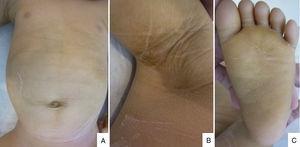 (A) Generalized xerosis with fine desquamation on the trunk. (B) Hyperkeratotic and brownish skin on the armpits. (C) Hyperkeratotic skin on the soles.