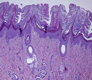 A skin biopsy from an armpit revealed hyperkeratosis, psoriasiform epidermal hyperplasia and slightly thickened granular layer in epidermis, and mild perivascular inflammatory infiltrate of mononuclear cells in papillary dermis (H&E 4×).