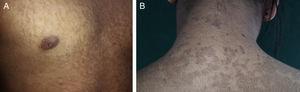 Aspecto clínico de las lesiones: placas pardas reticuladas y confluentes en el tórax anterior (A) y la nuca (B).