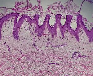 Hallazgos histológicos en la biopsia de piel: epidermis con leve hiperqueratosis. Acantosis y papilomatosis de las crestas interpapilares. En la dermis infiltrado inflamatorio perivascular (HE ×10).