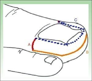 Línea A: línea transversa desde el extremo lateral del pliegue ungueal proximal hasta el límite externo del tejido hipertrófico. Línea B: inicia perpendicular a la primera y paralela a los pliegues ungueales laterales y distal de la uña, terminando en el mismo punto inicial, contralateral. Línea C (punteada): demarca el área a despegar que debe realizarse para completar la exéresis en U.